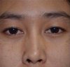 ก่อนทำ ตา 2 ชั้น หมอเปิ้ล.jpg