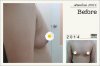 ก่อน เสริมหน้าอก เอเมด คลินิก_amed clinic.jpg