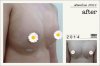หลัง เสริมหน้าอก เอเมด คลินิก_amed clinic.jpg