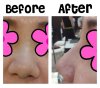 ก่อน-หลังเสริมจมูก2.jpg