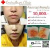 ผ่าตัดไขมันกระพุ้งแก้ม2.jpg