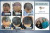 ปลูกผม-สุ.jpg