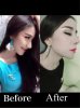 งานแก้ขูด filler กับ lift.jpg งานแก้ขูด filler กับ lift.jpg