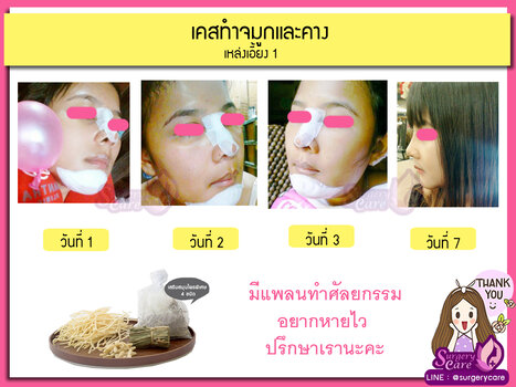 จมูกคาง1.jpg