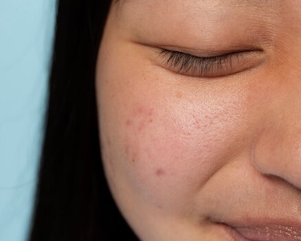 acne scar treatment1.jpg
