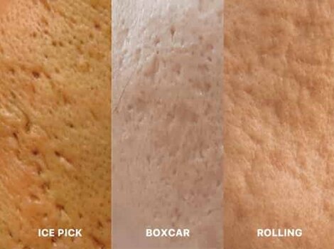 acne scar treatment3.jpeg