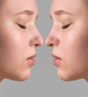 rhinoplasty surgery2.jpg