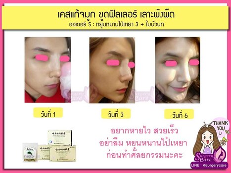 เคสแก้จมูก ขูดฟิลเลอร์ เลาะพังผืด.jpg