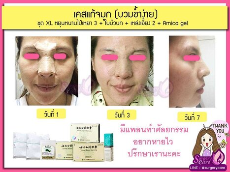 แก้จมูก บวมช้ำง่าย.jpg