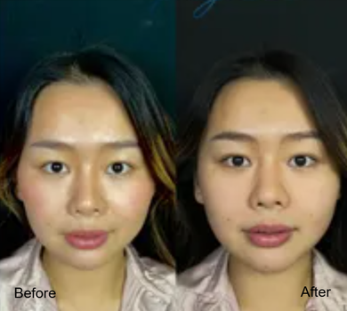 V Clinic by Dr.Fang_เชียงราย-Ultraformer III-2.png