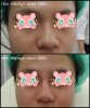 ก่อน-หลัง เสริมจมูก แบบฉีดฟิลเลอร์ เอเมด คลินิก Amed Clinic 1.jpg