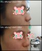 ก่อน-หลัง เสริมจมูก แบบฉีดฟิลเลอร์ เอเมด คลินิก Amed Clinic 2.jpg