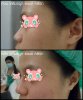 ก่อน-หลัง เสริมจมูก แบบฉีดฟิลเลอร์ เอเมด คลินิก Amed Clinic 3.jpg