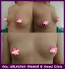 ก่อน เสริมหน้าอก ฟิลเลอร์ เอเมด คลินิก Amed Clinic.jpg