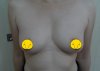 เสริมหน้าอก แบบฉีดฟิลเลอร์ เอเมด คลินิก Amed Clinic ศัลยกรรม รีวิว รีวิวศัลยกรรม b1.JPG