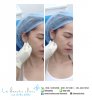 Botox-Lift.jpg