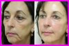 BeforeAfter-22-300x201.jpg