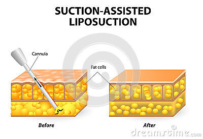 liposuction-mechanism-suction-assisted-hollow-tube-cannula-which-inserted-small-incision-skin