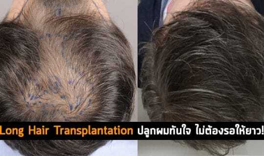 Long Hair Transplantation